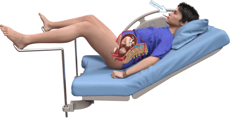 Méthode Guillarme - Orienter les pressions vers le bas